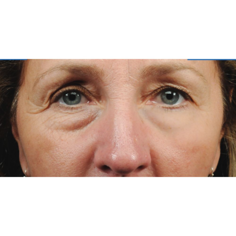 Elicina, ECO XT Eye Contour